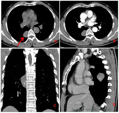 Posterior Mediastinal Epithelioid Angiosarcoma Arising in Schwannoma: A Case Report and Review of the Literature